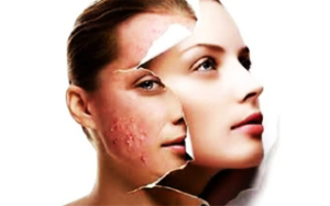 Tratamento de Acne - Centro de estética buona pelle