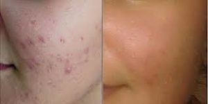 tratamento de acne no buritis centro-de-estetica-buonapelle